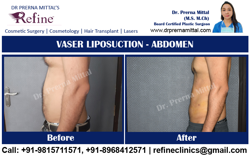 liposuction for abdomen in ludhiana