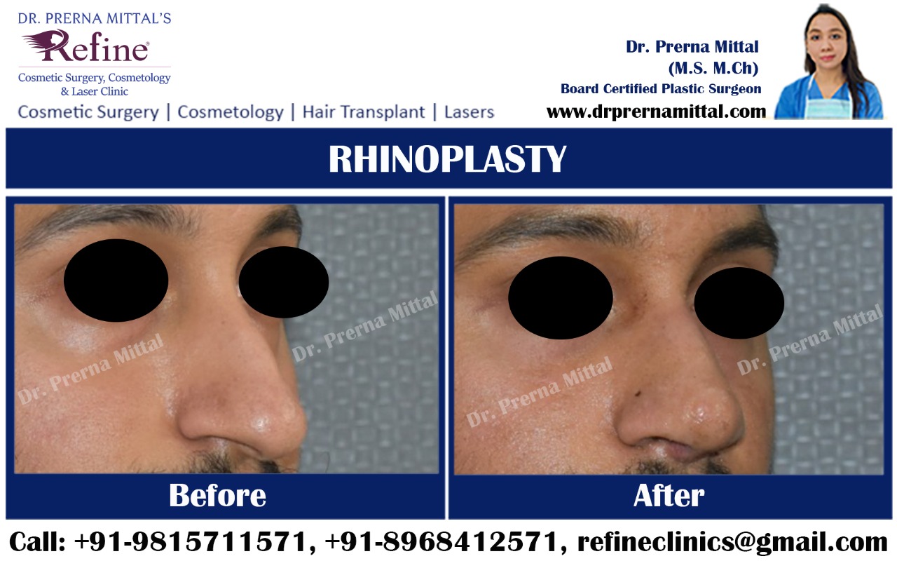rhinoplasty cost in India
