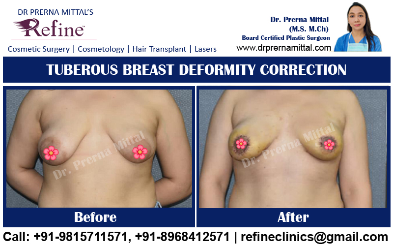 tuberous breast deformity treatment in Ludhiana
