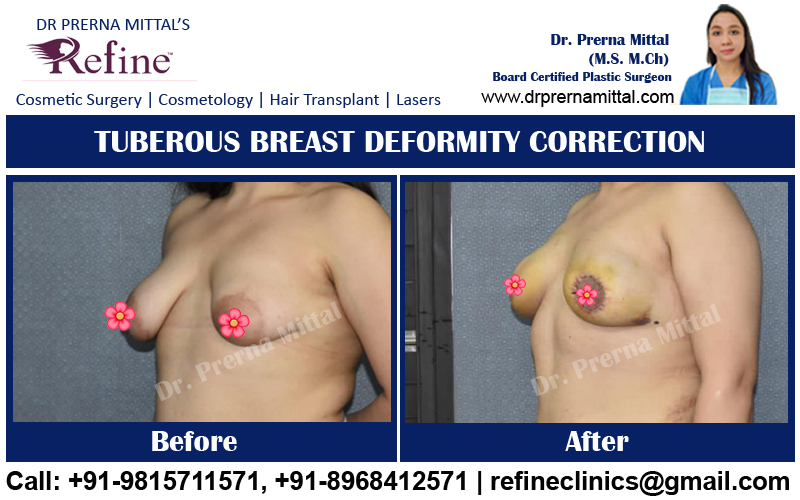 tuberous breast deformity correction in Ludhiana