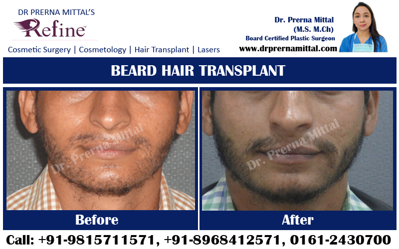 Beard hair transplant ludhiana