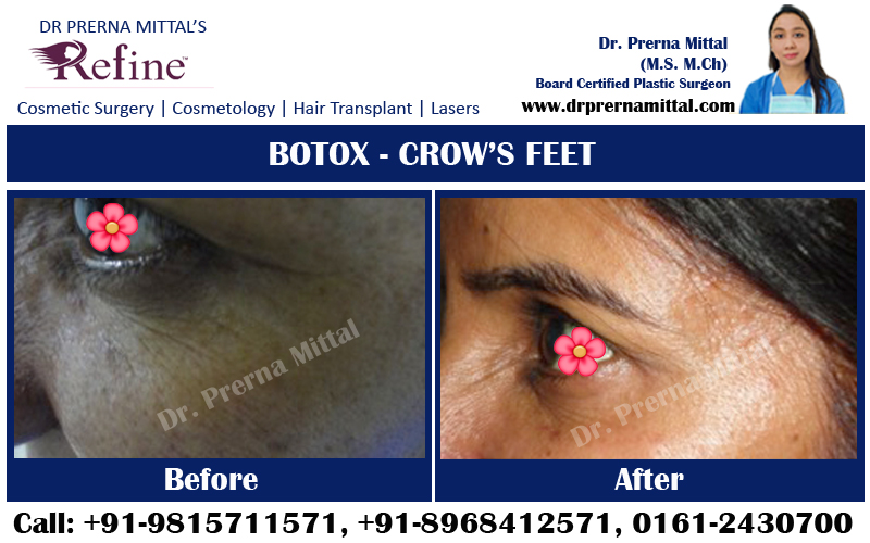 botox for forehead lines