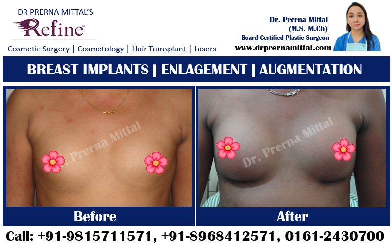 breast implants punjab