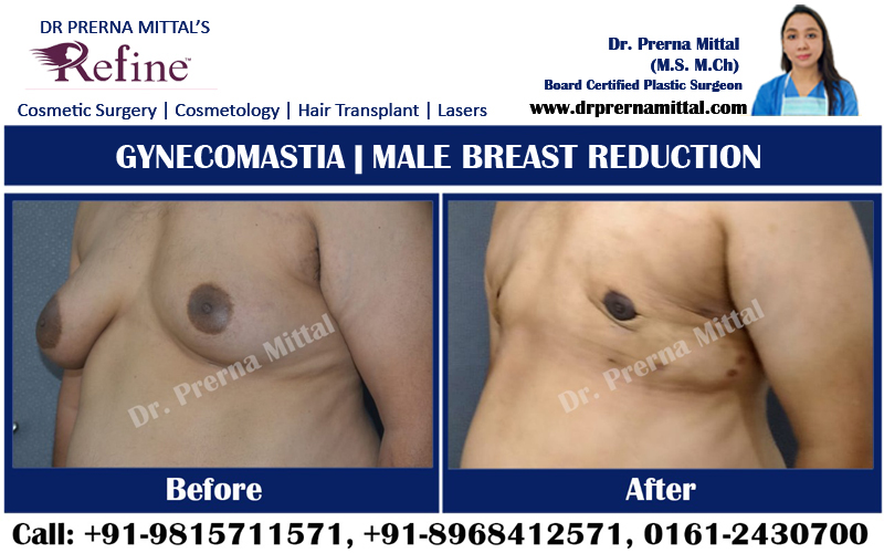 male breast reduction surgery in ludhiana