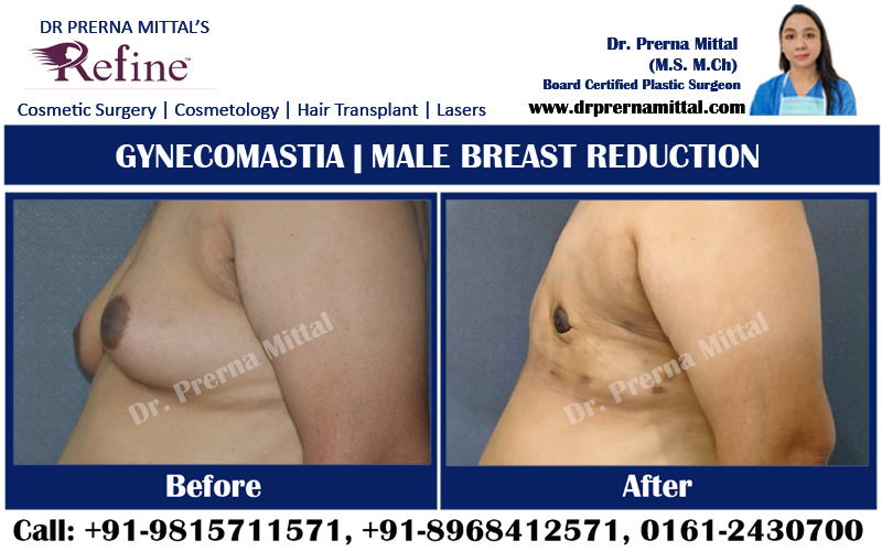 male breast reduction cost in Punjab