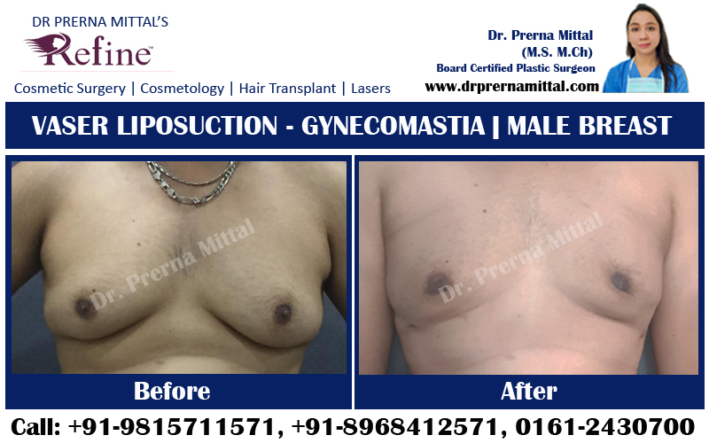male breast correction in punjab