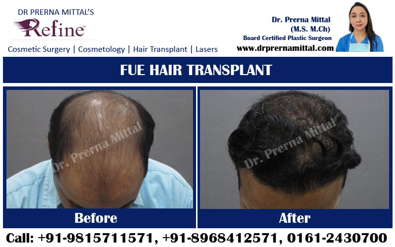 hair loss treatment in ludhiana