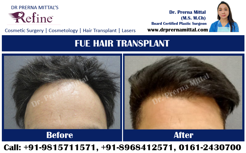 Hair Transplant in Ludhiana, Moga, Jagraon, Punjab | Hair Transplant Cost  in Amritsar, Jalandhar, Punjab
