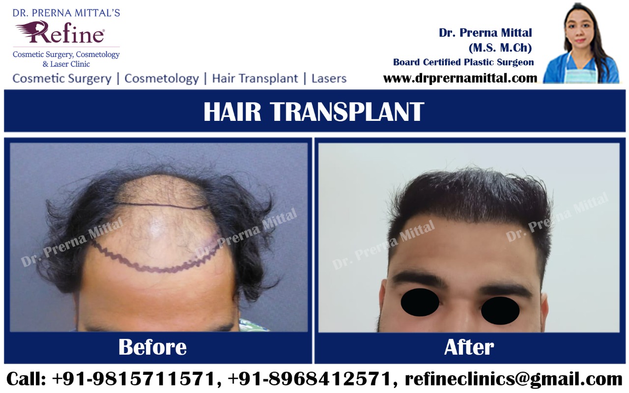 Hair Transplant Clinic in Ludhiana