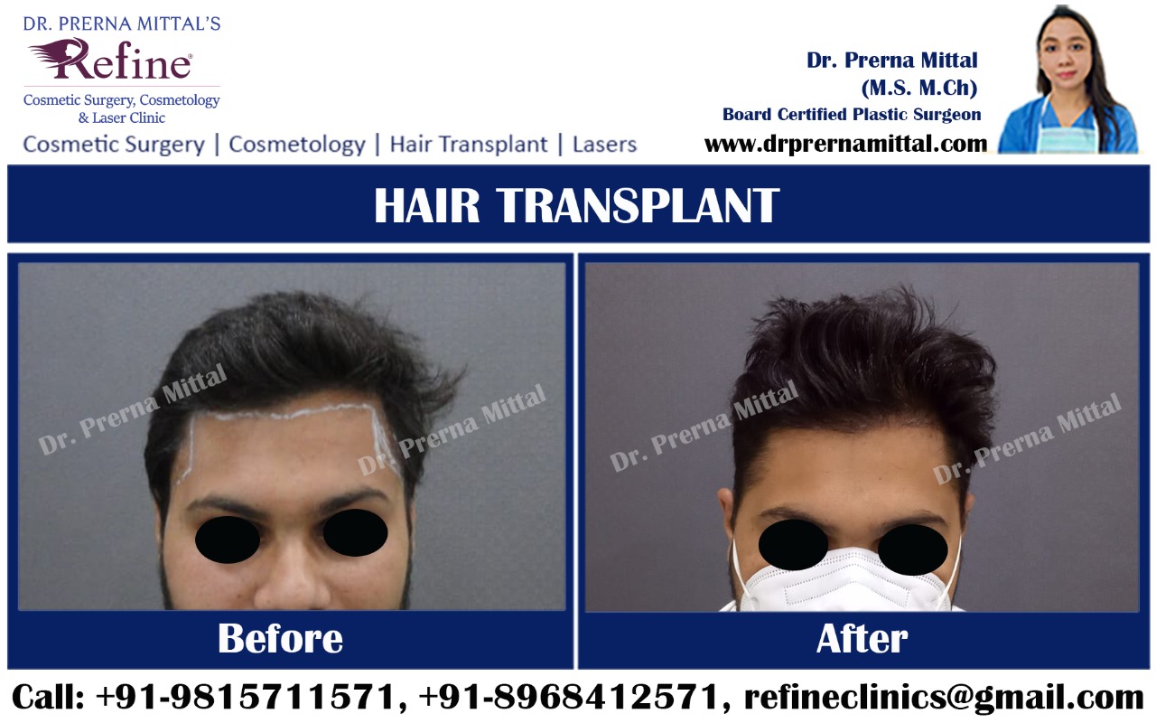 Hair Transplant surgery