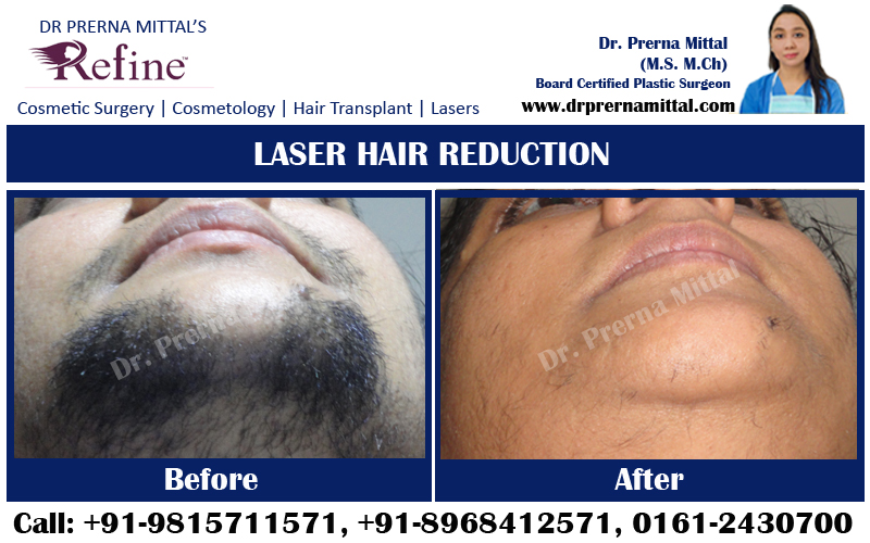 Laser Hair Reduction in ludhiana