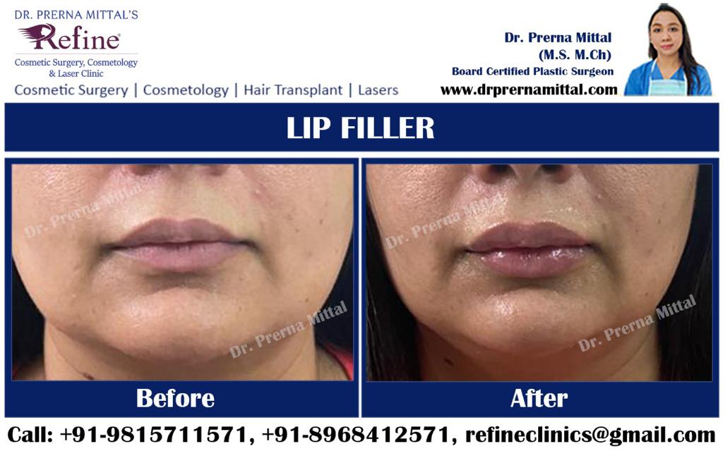 Lip Filler treatment in Punjab