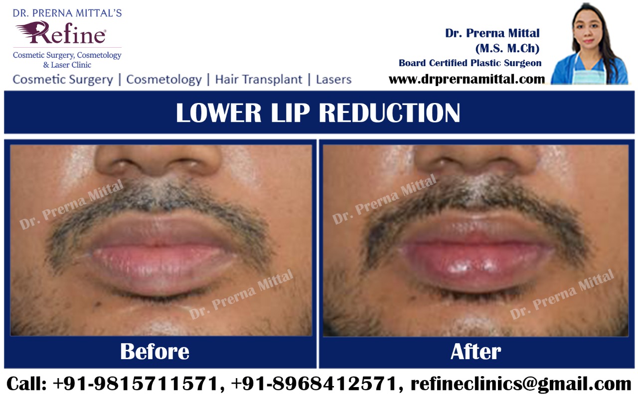 lip reduction surgery in ludhiana