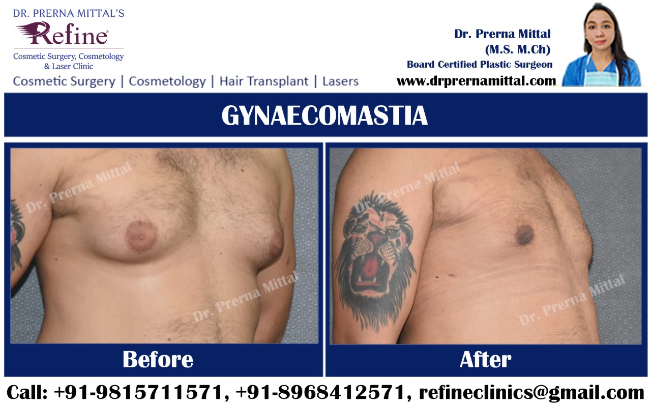 male breast reduction surgery