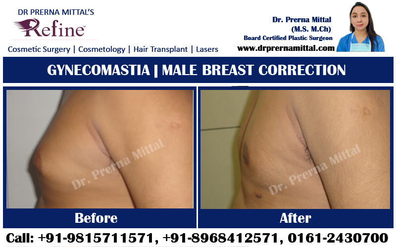 male breast reduction in punjab