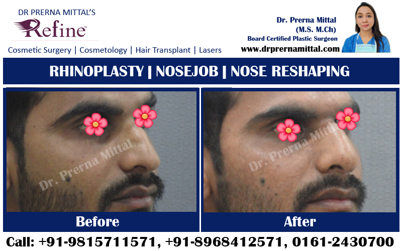 nose surgery in punjab
