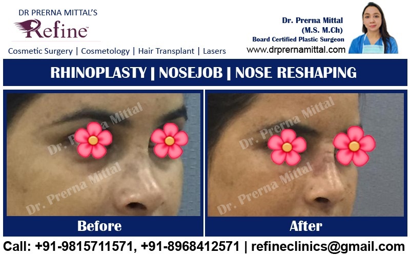 nose reshaping in ludhiana