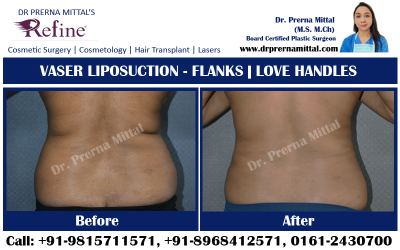 liposuction for abdomen in ludhiana
